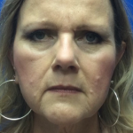 HourLift Before & After Patient #9994