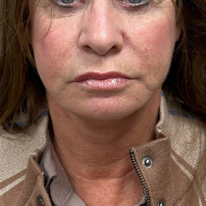 Neck Lift Before & After Patient #9950
