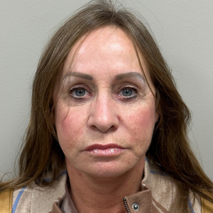 HourLift Before & After Patient #9949