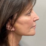 HourLift Before & After Patient #9988