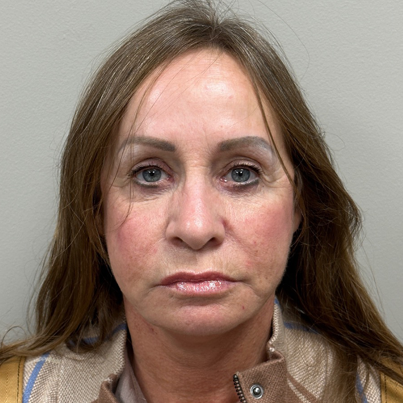 HourLift Before & After Patient #9949