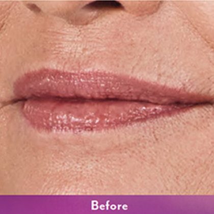 Volbella Before & After Patient #9978