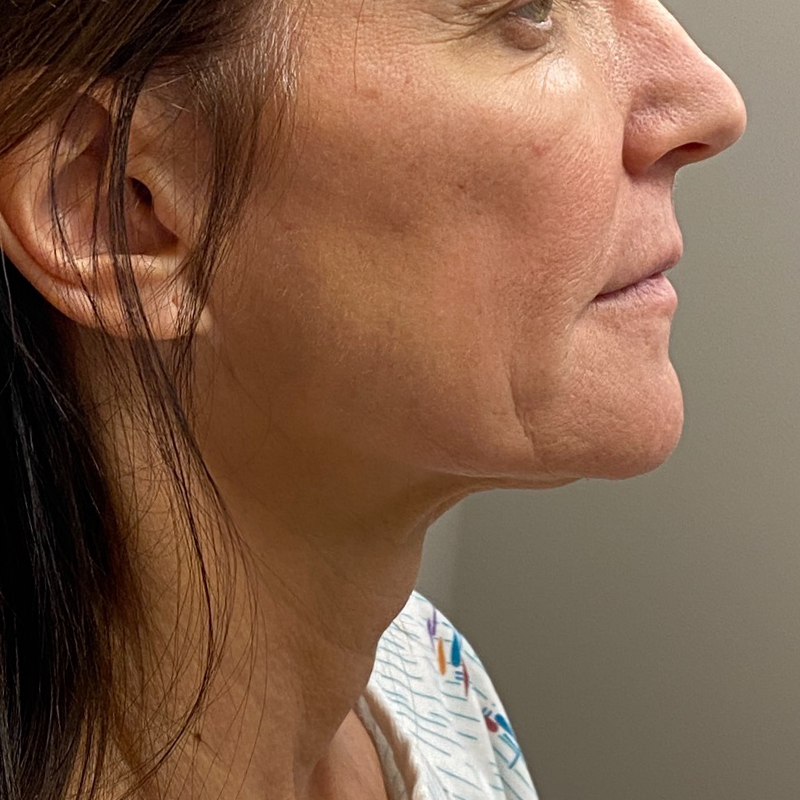 Neck Lift Before & After Patient #9991