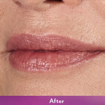 Volbella Before & After Patient #9978