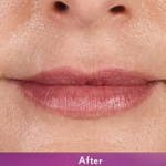 Volbella Before & After Patient #9973