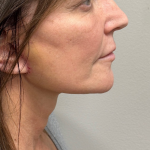 Neck Lift Before & After Patient #9991