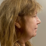 HourLift Before & After Patient #10063