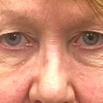 Blepharoplasty Before & After Patient #10072