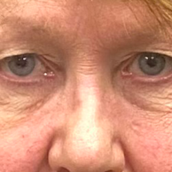 Blepharoplasty Before & After Patient #10072