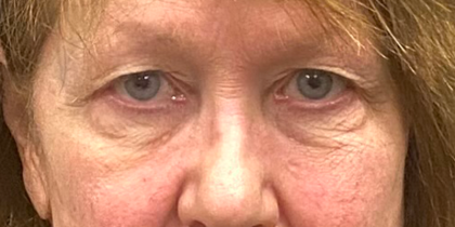 Blepharoplasty Before & After Patient #10072