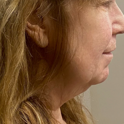 Neck Lift Before & After Patient #10073