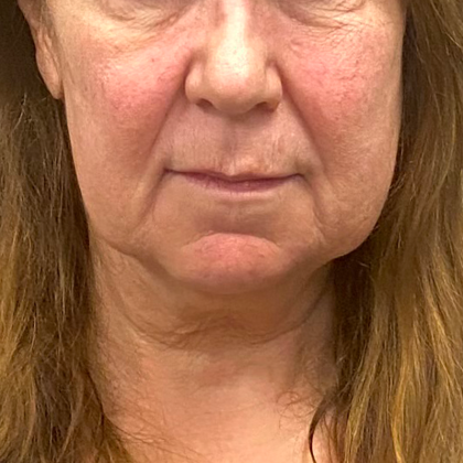 Neck Lift Before & After Patient #10073