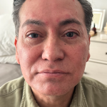 Y Lift Before & After Patient #10088