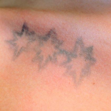 Tattoo Removal Before & After Patient #10106