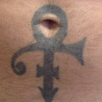 Tattoo Removal Before & After Patient #10112