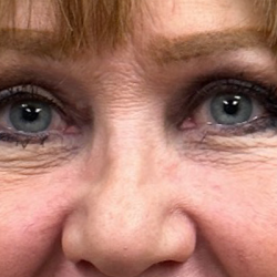 Blepharoplasty Before & After Patient #10072