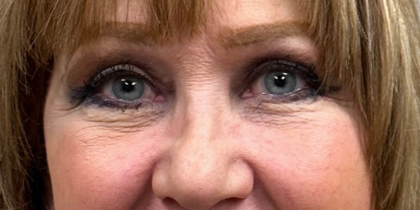 Blepharoplasty Before & After Patient #10072