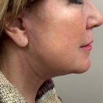 Neck Lift Before & After Patient #10073