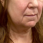 Neck Lift Before & After Patient #10073