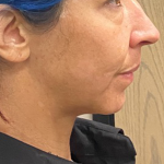 Neck Lift Before & After Patient #10086