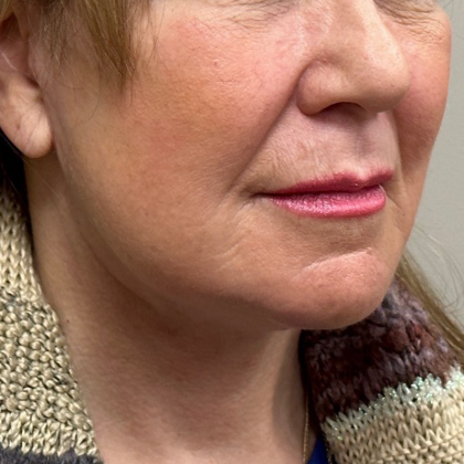 Neck Lift Before & After Patient #10073