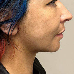 Neck Lift Before & After Patient #10086