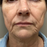 Neck Lift Before & After Patient #10138