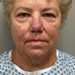 HourLift Before & After Patient #10143