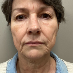 HourLift Before & After Patient #10133