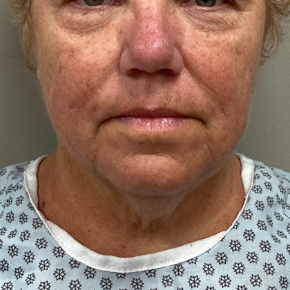 Neck Lift Before & After Patient #10146