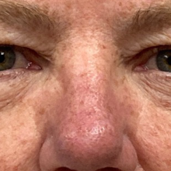Blepharoplasty Before & After Patient #10149