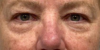 Blepharoplasty Before & After Patient #10149
