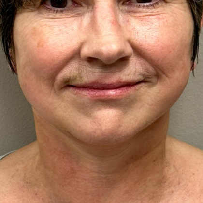 Neck Lift Before & After Patient #10138