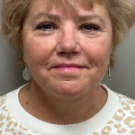 HourLift Before & After Patient #10143
