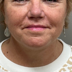 Neck Lift Before & After Patient #10146