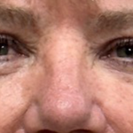 Blepharoplasty Before & After Patient #10149