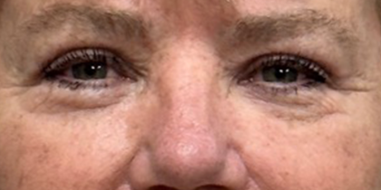 Blepharoplasty Before & After Patient #10149