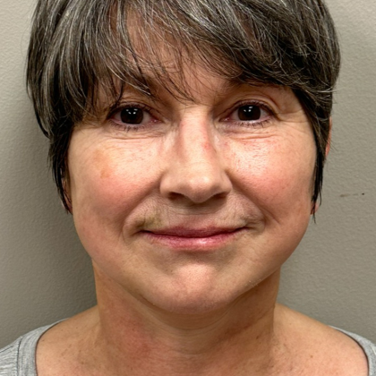 HourLift Before & After Patient #10133