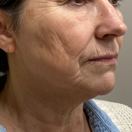 Neck Lift Before & After Patient #10138