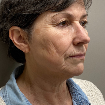 HourLift Before & After Patient #10133
