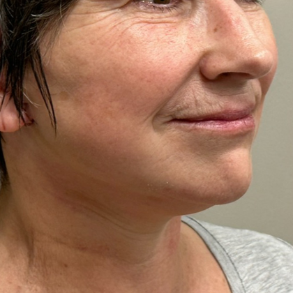 Neck Lift Before & After Patient #10138
