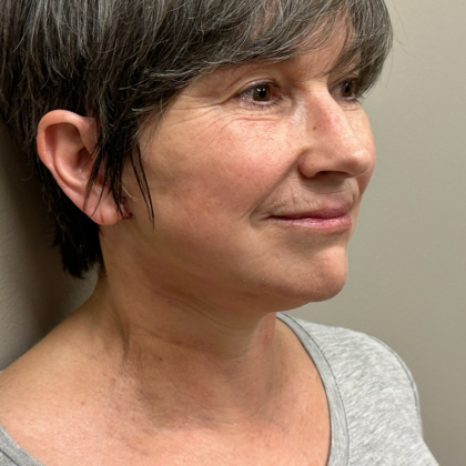 HourLift Before & After Patient #10133