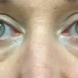 Blepharoplasty Before & After Patient #10173