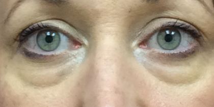Blepharoplasty Before & After Patient #10173