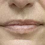 Revanesse Versa - Lips Before & After Patient #10176