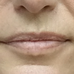 Pretty Lips Before & After Patient #10176