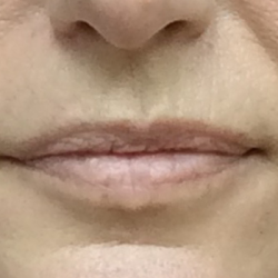 Pretty Lips Before & After Patient #10176