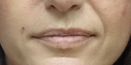 Pretty Lips Before & After Patient #10176