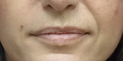 Revanesse Versa - Lips Before & After Patient #10176