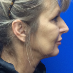 HourLift Before & After Patient #10179